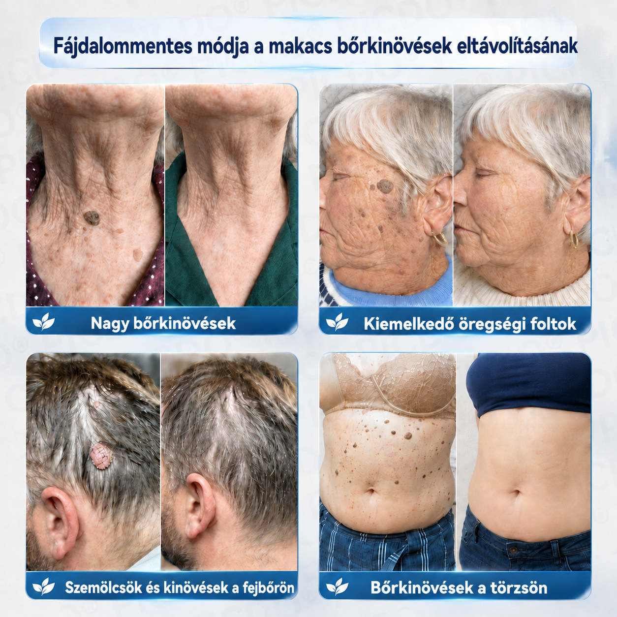 Picdo® 7‑denní krém k odstraňování kožních výrůstků a pigmentových skvrn 🧴(𝐒𝐜𝐡𝐦𝐞𝐫𝐳𝐟𝐫𝐞𝐢𝐞 𝐅𝐨𝐫𝐦𝐞𝐥 – 𝐨𝐡𝐧𝐞 𝐍𝐚𝐫𝐛𝐞𝐧) 💧