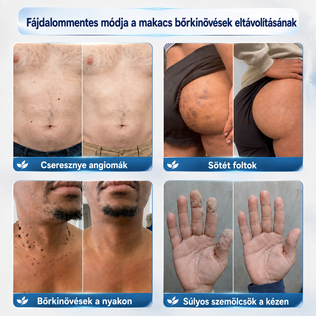 Picdo® 7‑denní krém k odstraňování kožních výrůstků a pigmentových skvrn 🧴(𝐒𝐜𝐡𝐦𝐞𝐫𝐳𝐟𝐫𝐞𝐢𝐞 𝐅𝐨𝐫𝐦𝐞𝐥 – 𝐨𝐡𝐧𝐞 𝐍𝐚𝐫𝐛𝐞𝐧) 💧