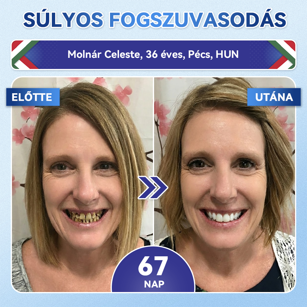 🦷 𝐆𝐥𝐢𝐦𝐦𝐞𝐫𝐥𝐲® 𝐓𝐢𝐝𝐞𝐠𝐥𝐮𝐬𝐢𝐛 Fog- és Ínyregeneráló Mikrotűs Párna | Fejlett Őssejtes Aktiválás Fogfehérítő Csíkok (🦷 Fogzománc és Dentin Újraépítése • Ínyerősítés • Fogatlanodás és Szageltávolítás • Fogérzékenység Megállítása)🐊