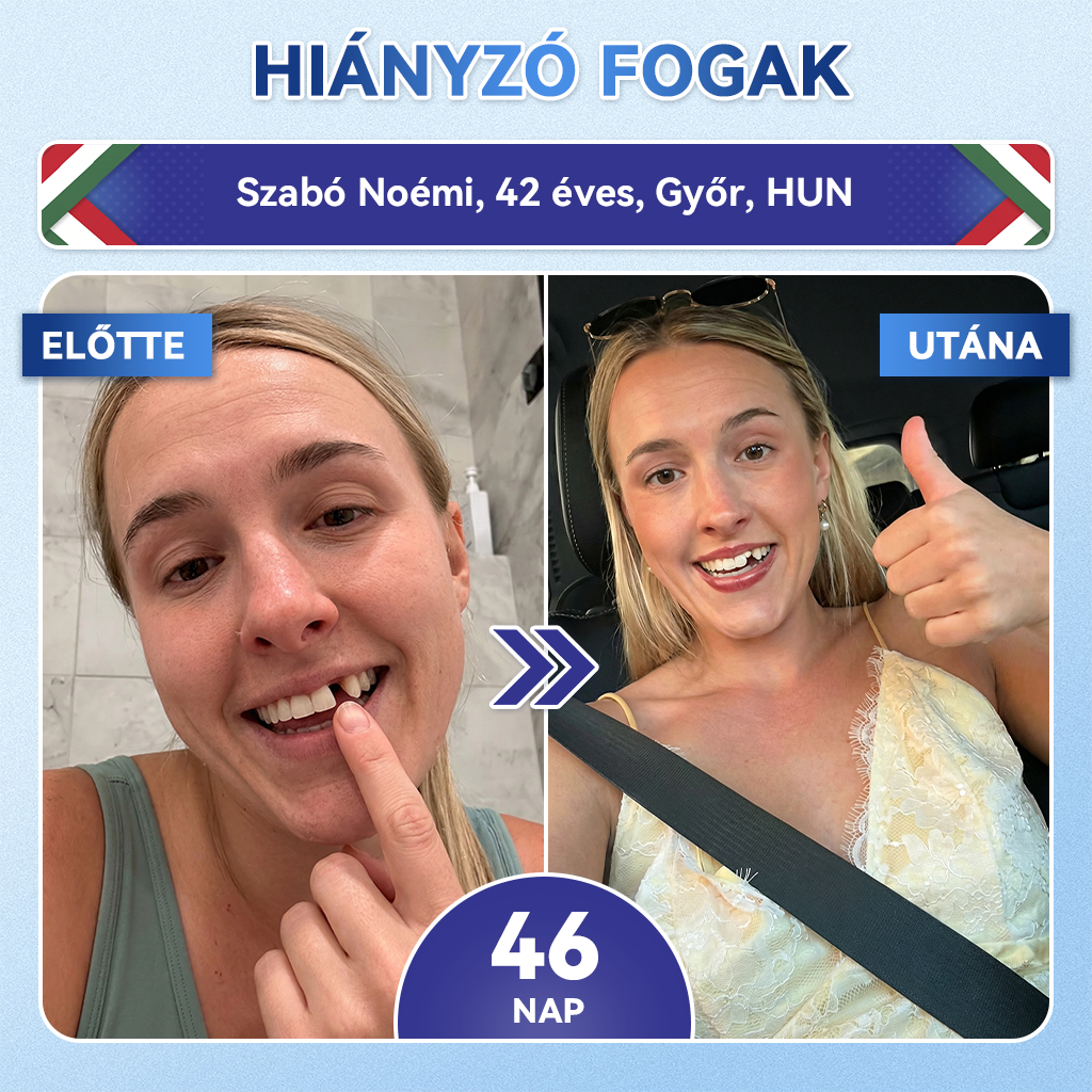🦷 𝐆𝐥𝐢𝐦𝐦𝐞𝐫𝐥𝐲® 𝐓𝐢𝐝𝐞𝐠𝐥𝐮𝐬𝐢𝐛 Fog- és Ínyregeneráló Mikrotűs Párna | Fejlett Őssejtes Aktiválás Fogfehérítő Csíkok (🦷 Fogzománc és Dentin Újraépítése • Ínyerősítés • Fogatlanodás és Szageltávolítás • Fogérzékenység Megállítása)🐊