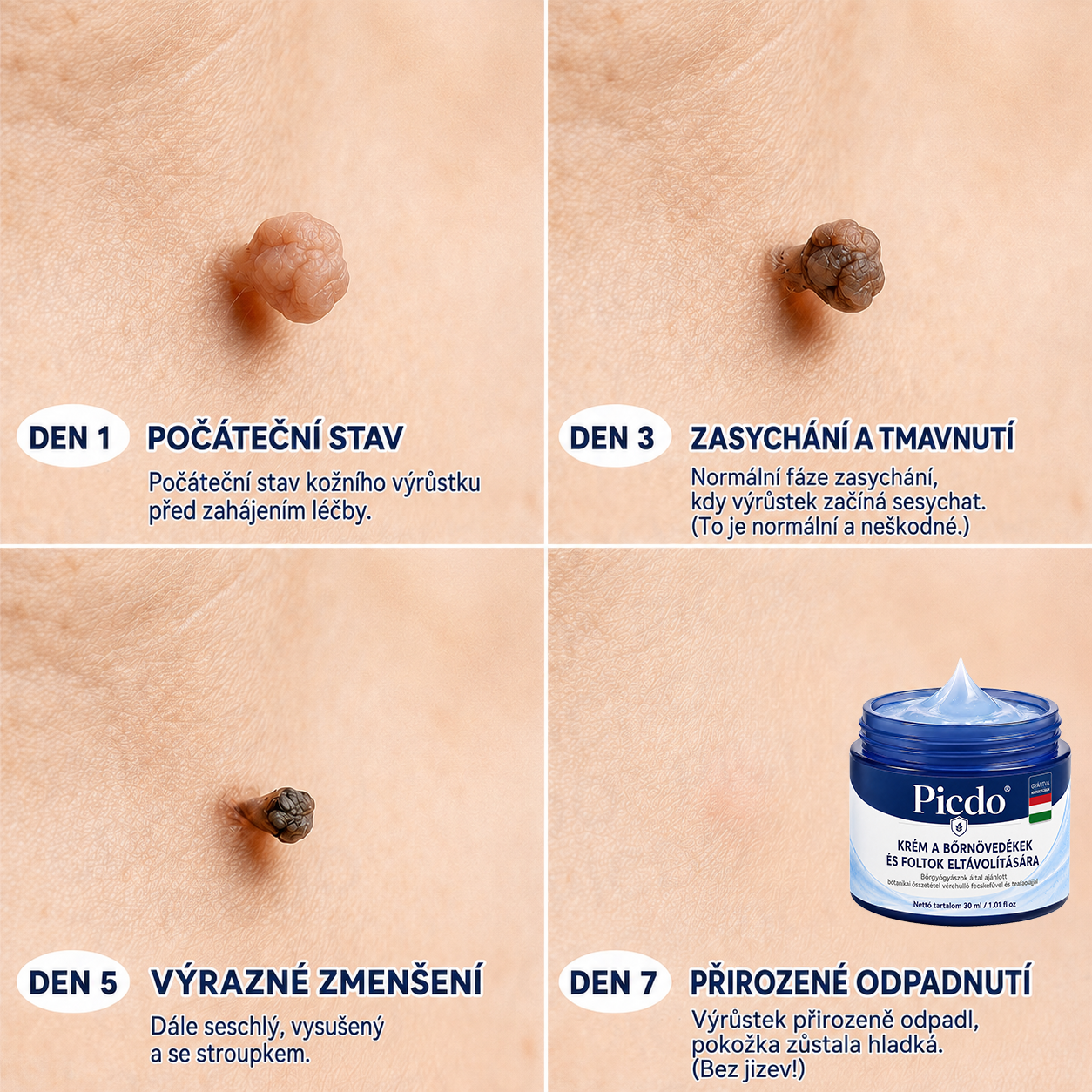 Picdo® 7‑denní krém k odstraňování kožních výrůstků a pigmentových skvrn 🧴(𝐒𝐜𝐡𝐦𝐞𝐫𝐳𝐟𝐫𝐞𝐢𝐞 𝐅𝐨𝐫𝐦𝐞𝐥 – 𝐨𝐡𝐧𝐞 𝐍𝐚𝐫𝐛𝐞𝐧) 💧